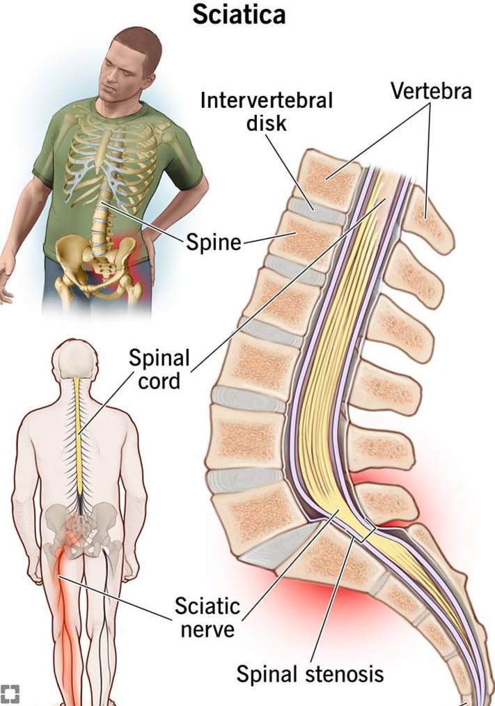 Understanding Sciatica