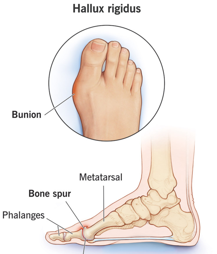 Toe Joint Pain