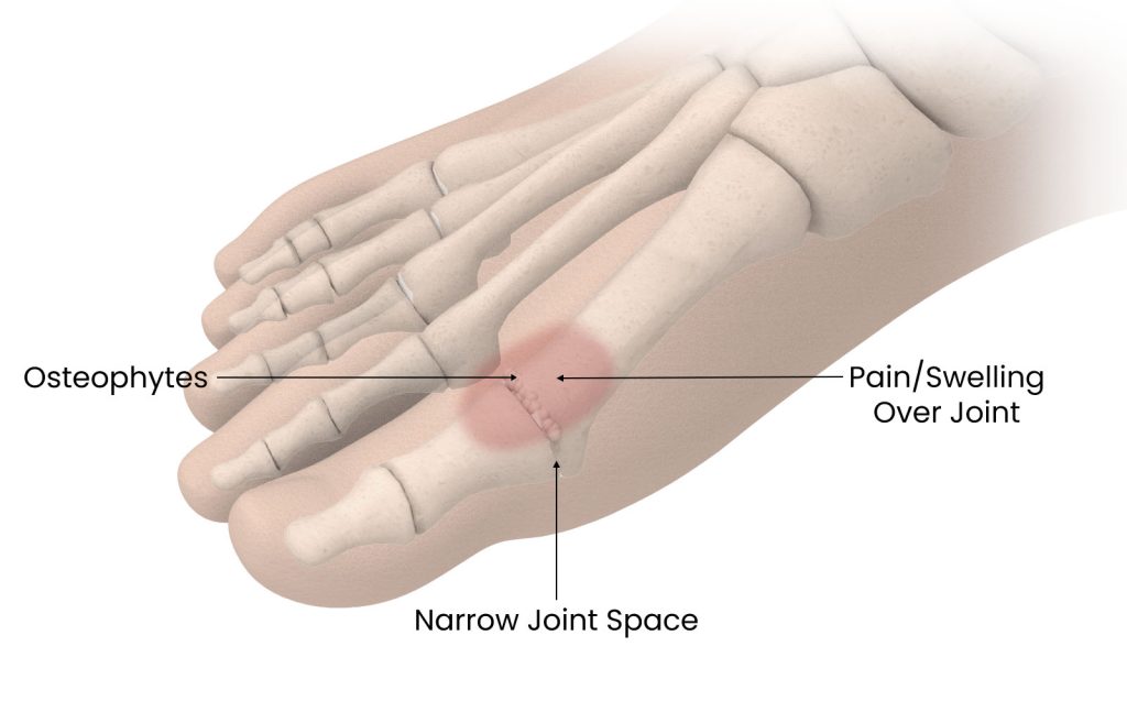 hallux rigidus
