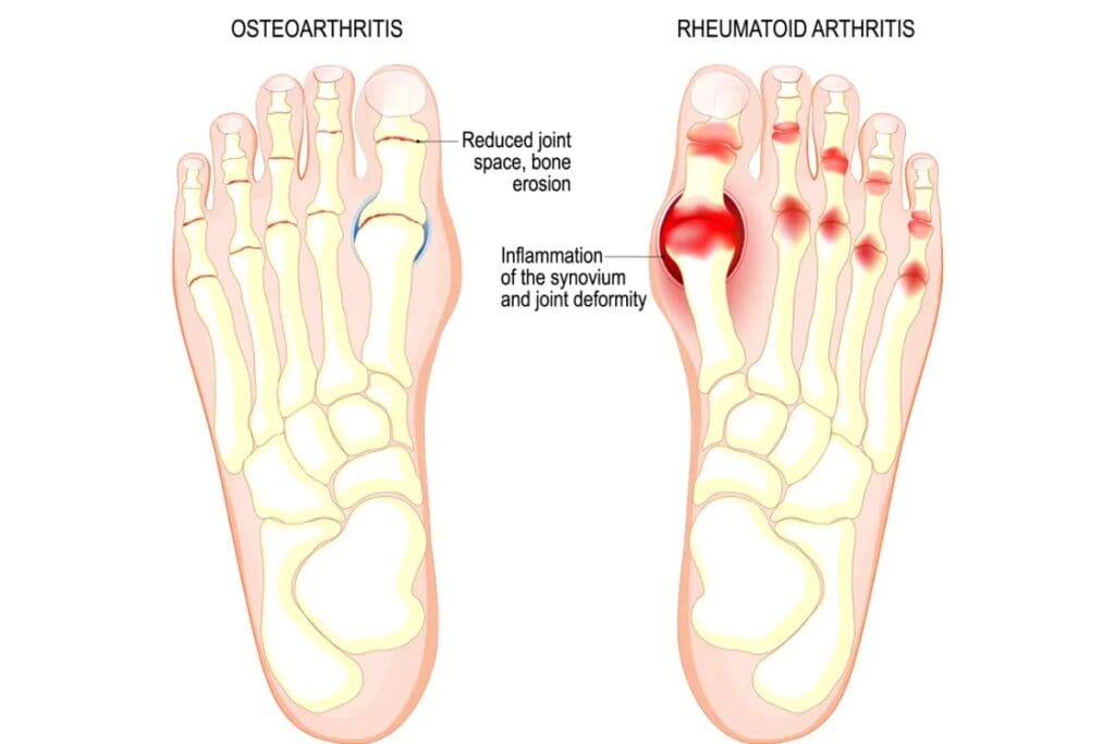 Toe Joint Pain