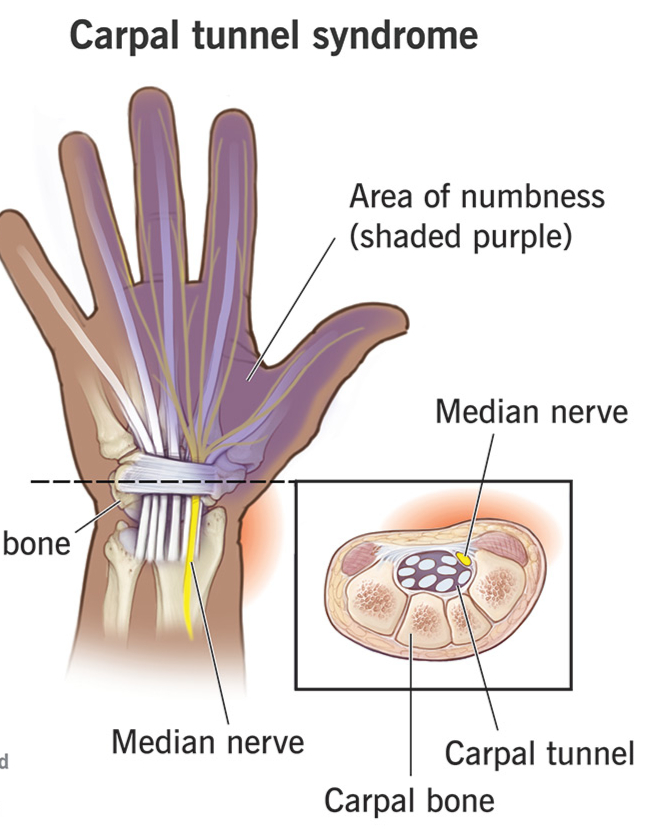 Carpal Tunnel Syndrome