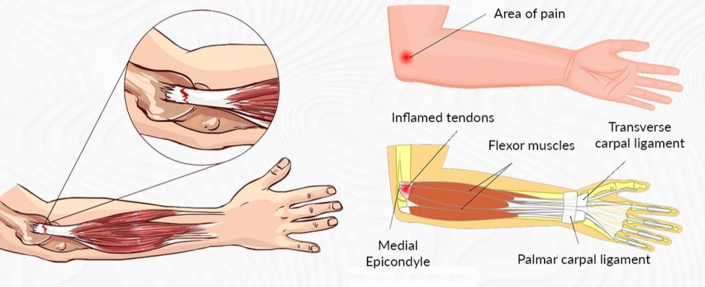 Elbow Joint Pain