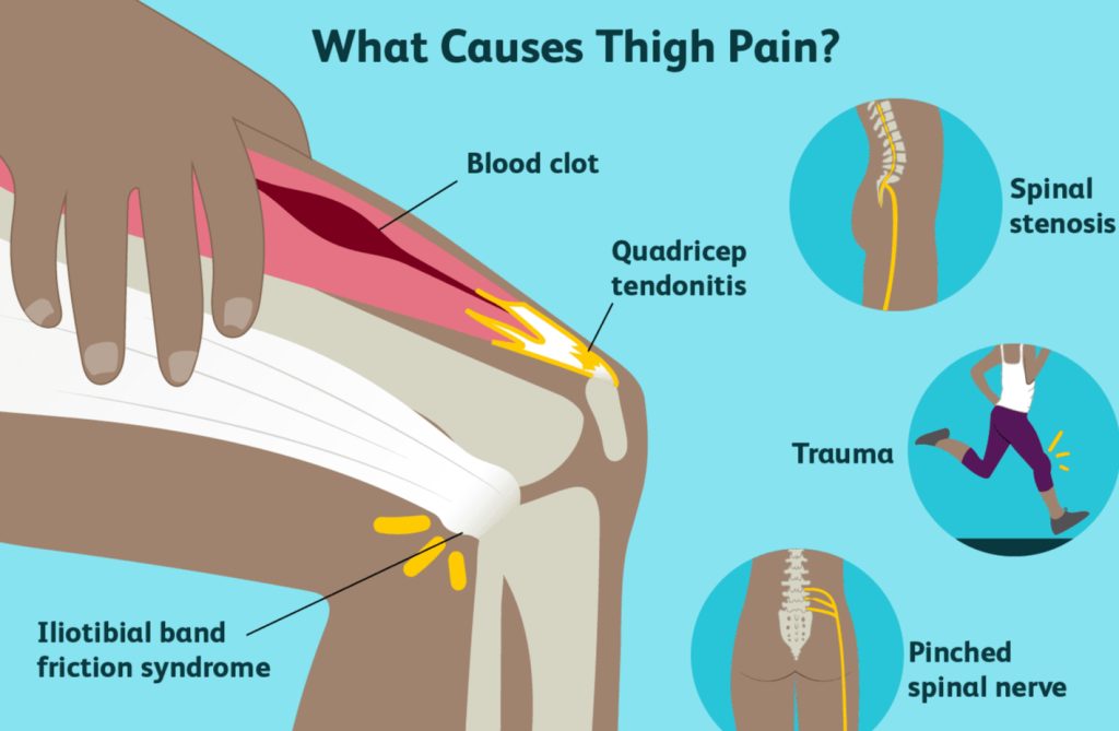 Thigh Pain