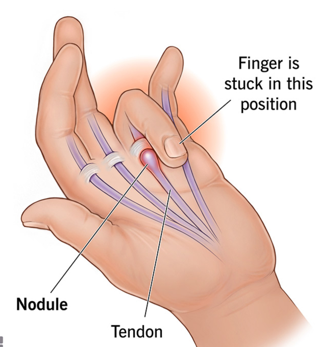 Finger Joint Pain