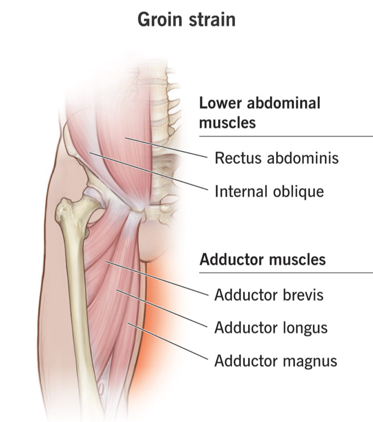 Groin Pain