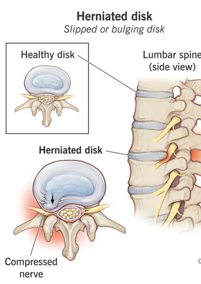 Slipped Disc