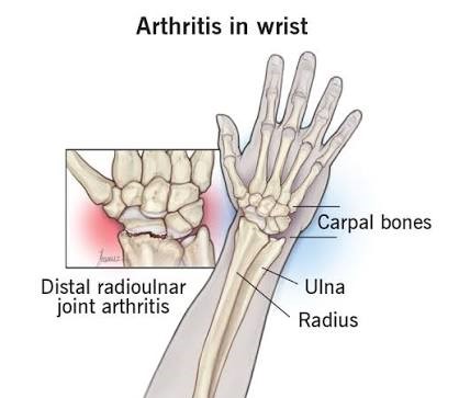 Wrist Joint Pain