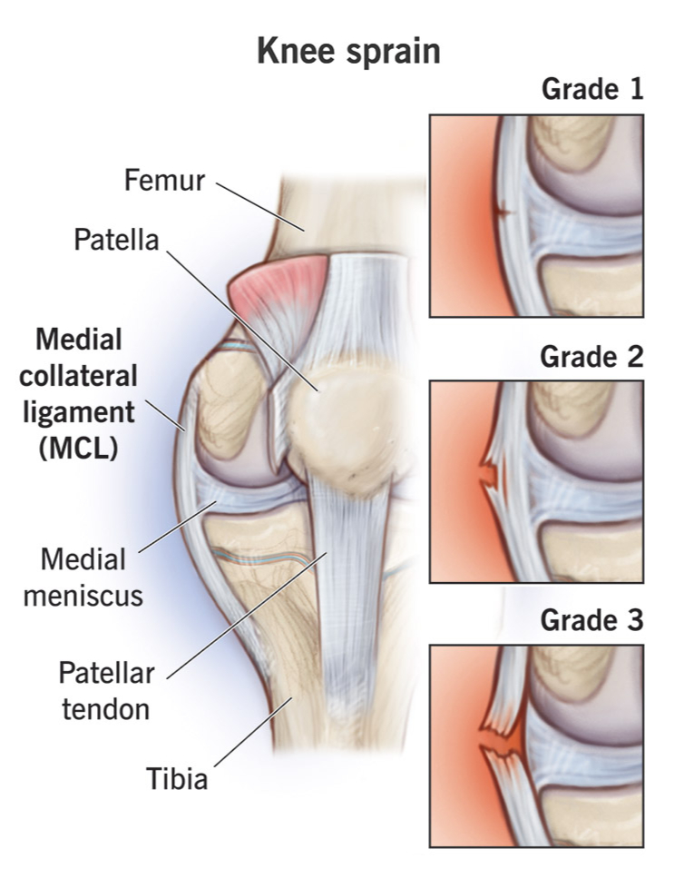 Knee Ligament Injuries