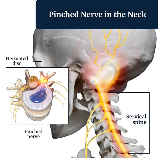 Pinched Nerve in Neck