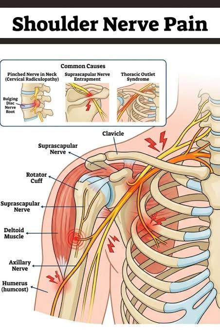 Pinched Nerve in Shoulder Blade